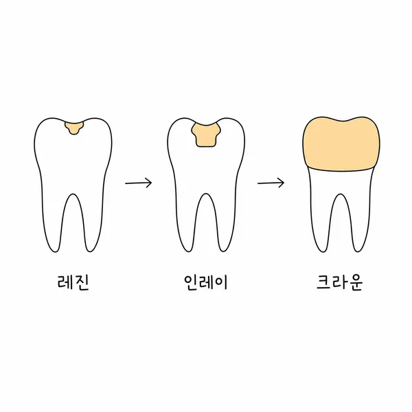 레진 인레이 크라운으로 이어지는 충치치료 단계 비교 이미지